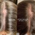preventia impotriva caderii parului, rehair by ibrows