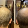 ReHair by iBrows